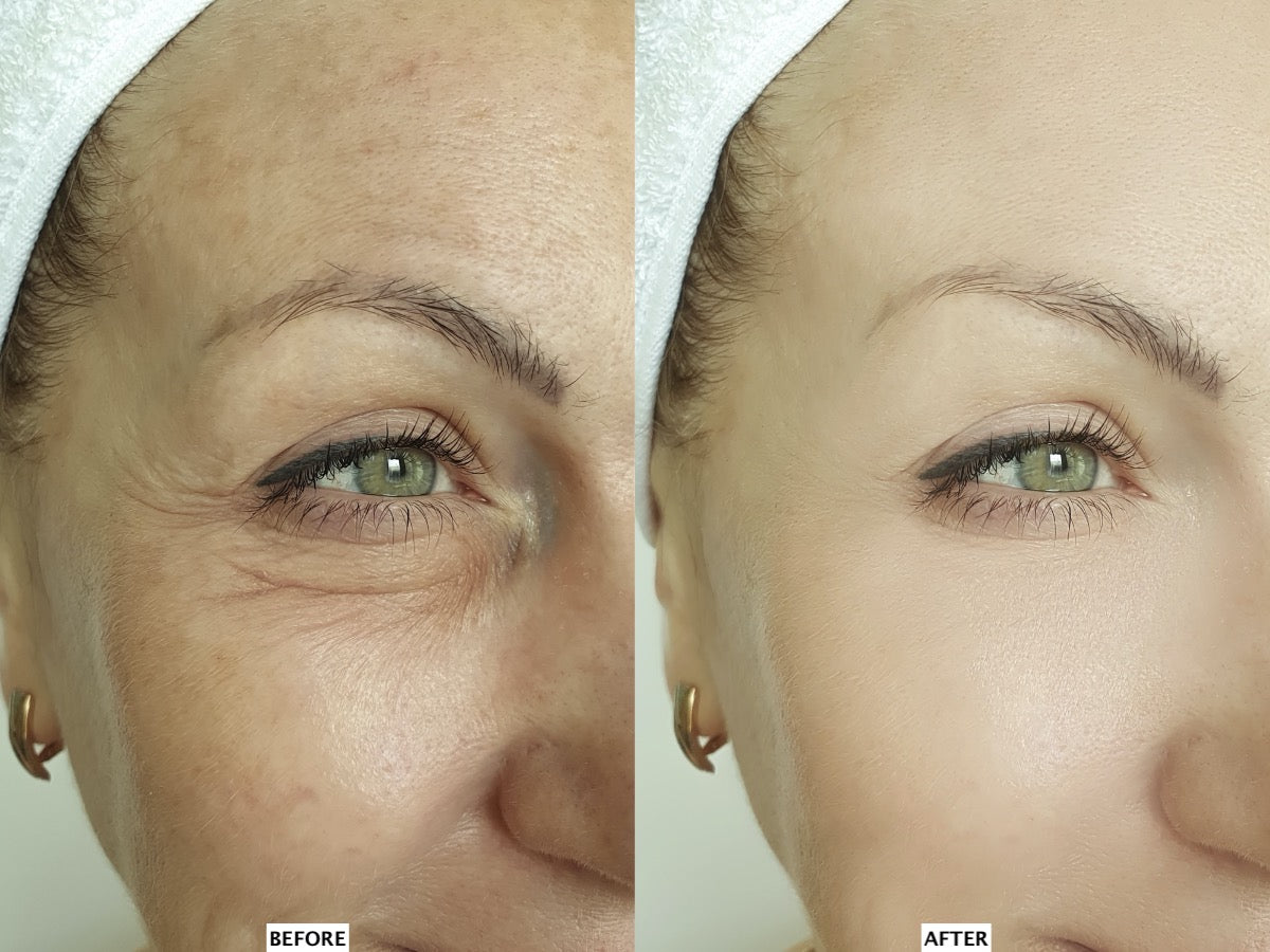 Leaf Fusion Plasma device before and after | Microneedling without Needles | Face vital
